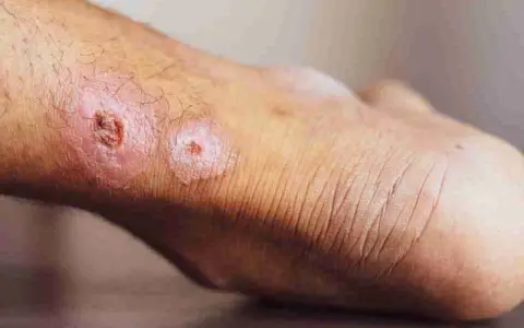 Pelle del piede con lesioni infiammate, arrossate e crostose, che suggeriscono un forte dolore alla pelle al tatto.