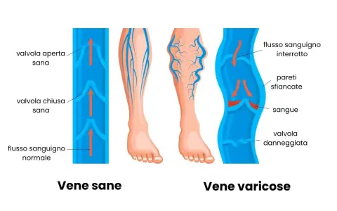 Illustrazione che mostra vene sane e vene varicose, evidenziando i problemi di insufficienza venosa gambe rimedi.