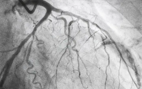 Immagine radiografica del cuore, mostrando le arterie coronarie dopo una coronarografia. Un passo importante nella convalescenza.