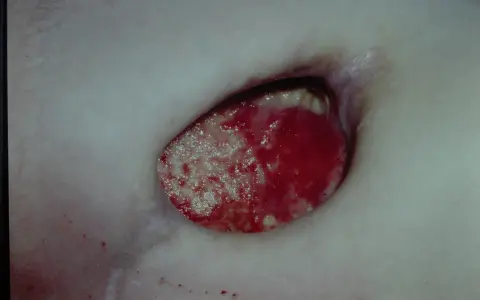 Piaga da decubito sacrale con tessuto necrotico e granulazione. Guida su come curare piaghe da decubito sacrali.