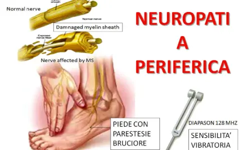 Illustrazione di neuropatia periferica con sintomi come parestesie e bruciore al piede, e diapason per testare la sensibilità vibratoria.