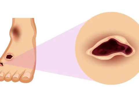 Ingrandimento di un piede con lesioni scure e profonde, che evidenzia la necessità di chi cura i piedi per trattare queste ferite.