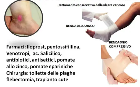 Trattamento conservativo per ulcere venose: bendaggio allo zinco e compressivo, farmaci e chirurgia.