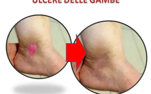 Prima e dopo: ulcere alle gambe che perdono acqua, ora in guarigione.