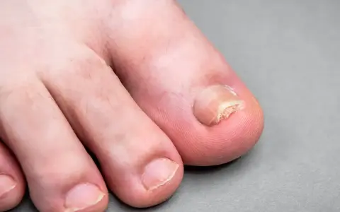 Unghia del piede affetta da onicogrifosi, ispessita e deformata. Scopri come curarla per ritrovare piedi sani.