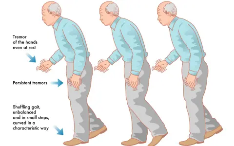 Uomo con tremori alle mani e andatura incerta, sintomi del parkinson. La difficoltà a parlare è un altro sintomo comune.