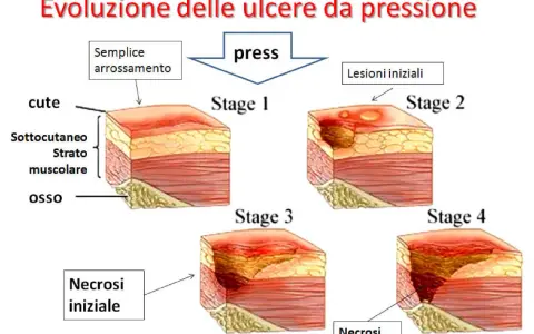 Evoluzione delle piaghe da decubito: da semplice arrossamento a necrosi profonda, mostrando le varie fasi di formazione.