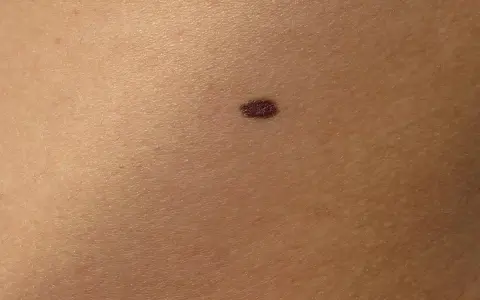 Un neo scuro sulla pelle, un piccolo punto che potrebbe nascondere insidie nei pericolosi.