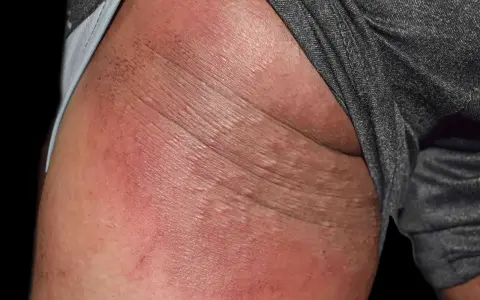 Arrossamento e piccole vescicole sulla pelle, indicative di dermatite sedere adulto.