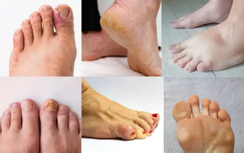 La podologia cos'è? Immagini di piedi con unghie incarnite, talloni screpolati, funghi, calli e gonfiore.