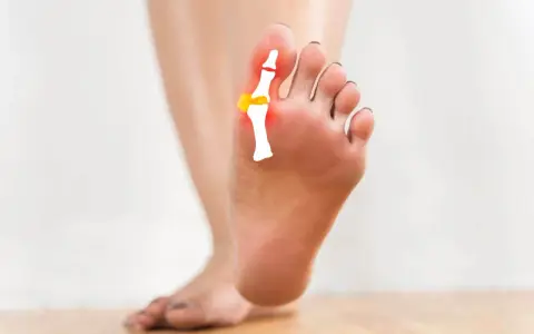 Piede con evidenziato un lieve alluce valgo, con schema osseo e zone rosse di infiammazione.