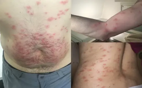 Punture di acaro su addome, braccio e schiena. Lesioni cutanee rosse e pruriginose diffuse.