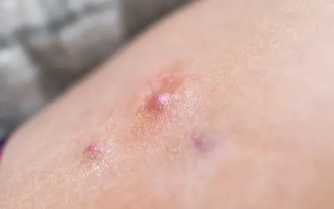 Pelle con arrossamento e piccole vescicole, indicative di dermatite bollosa.