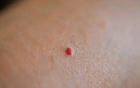 Piccola macchia rossa sulla pelle, un neo rubino che non prude.