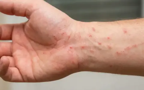 Pelle arrossata e irritata sul polso, con piccole pustole e graffi, sintomi di dermatiti da acaro.