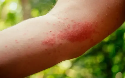 Arrossamento e piccoli pomfi sull'avambraccio: ecco come riconoscerla puntura ape.