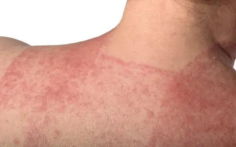 Pelle arrossata e irritata sulla spalla e sul collo, con chiazze evidenti. Potrebbe essere un caso di dermatite da incontinenza.