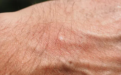 Pelle secca e arrossata con peli sottili, possibile prurito senile. Il trattamento per la xerosi cutanea è fondamentale.