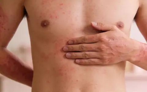 Torso e braccia di una persona con estese irritazioni cutanee rosse e pruriginose.