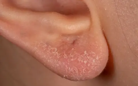 Orecchio con pelle arrossata e desquamata, sintomo di una possibile allergia al nichel.