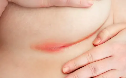 Pelle assottigliata da cortisone, arrossata e irritata. Si cercano rimedi per lenire l'infiammazione e ripristinare la barriera cutanea.