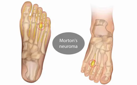 Illustrazione anatomica del piede che mostra un neuroma di Morton, una condizione che rende difficile camminare.