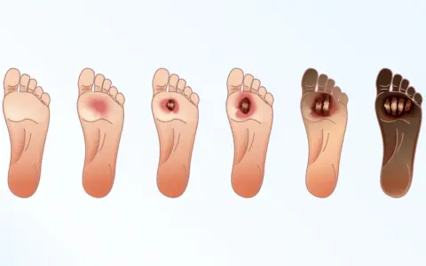 Progressione di ulcere al piede, dalla lieve infiammazione alla necrosi. Immagine illustra come disinfettare le ulcere alle gambe.
