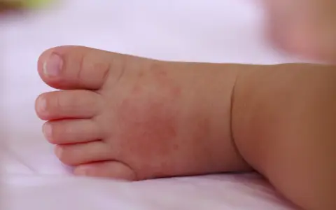 Piedino di neonato con piccoli puntini da sudore rossastri sulla pelle.