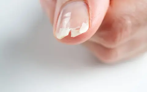 Unghie che si deformano, con strati che si sfaldano e si spezzano, mostrando fragilità.