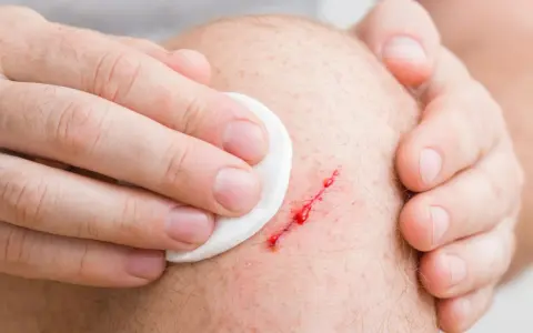 Mano che pulisce una ferita sanguinante sul ginocchio, segno di pelle che si lacera facilmente.