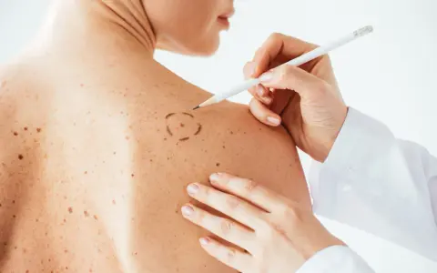 Medico disegna cerchio su neo per asportazione. La convalescenza dopo asportazione neo è un momento delicato.