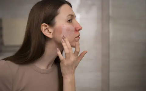 Donna applica crema su viso arrossato, cercando sollievo dalle piaghe della pelle.