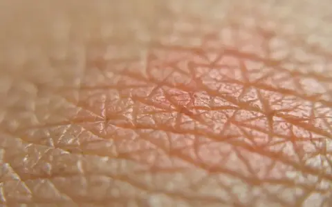 Close-up della pelle con arrossamento, suggerisce irritazione piega sedere rimedi.