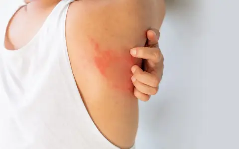 Un'eruzione cutanea rossa e pruriginosa sulla spalla, che fa sudare dietro la nuca per il disagio.