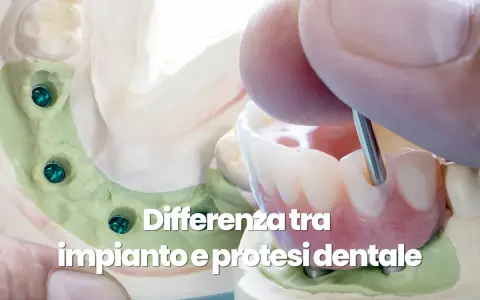 Modello dentale con impianti e protesi. L'igiene del cavo orale è fondamentale per la salute dei denti.