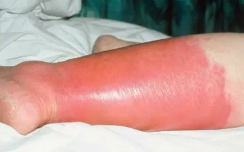 Gamba gonfia e arrossata, con segni di erisipela. La pelle appare lucida e tesa, con un'area di infiammazione estesa.