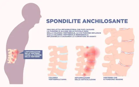 Spondilite anchilosante: infiammazione vertebrale che causa fusione ossea, rendendo la colonna rigida e curva in avanti.