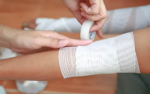 Applicazione di una fasciatura su un braccio, seguendo la regola del 9 ustioni per valutare l'estensione.