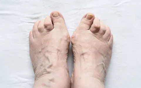 Piedi anziani con evidenti vene varicose e dita leggermente deformate, segno di piedi gonfi anziani.