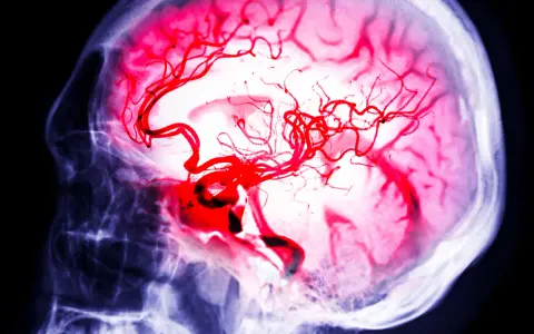 Immagine radiografica di un cervello con vasi sanguigni rossi evidenziati, che simboleggiano la lotta per l'aneurisma cerebrale sopravvivenza.