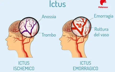 Ictus: confronto tra ischemico (trombo) ed emorragico (rottura vaso). L'emorragia cerebrale negli anziani è un rischio.