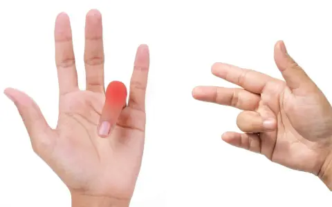 Mano con dito arrossato e un'altra mano che mostra movimenti per esercizi utili per dito a scatto.