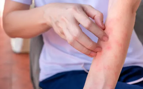 Braccio con pelle arrossata e puntini rossi, che indica la necessità di rimedi per l'irritazione cutanea.