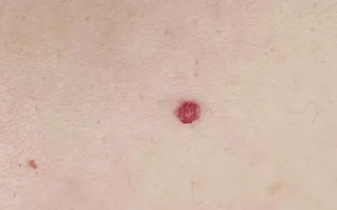 Una piccola macchia rossa sulla pelle, di forma quasi circolare, spicca sulla cute chiara.