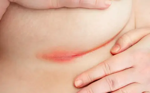 Arrossamento e irritazione cutanea sotto il seno, sintomo di dermatite da sudore. Mani che accarezzano delicatamente la zona interessata.
