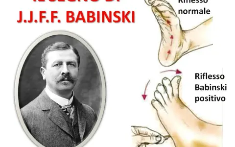 Ritratto di J.J.F. Babinski, con illustrazioni del riflesso normale e del riflesso di Babinski positivo.
