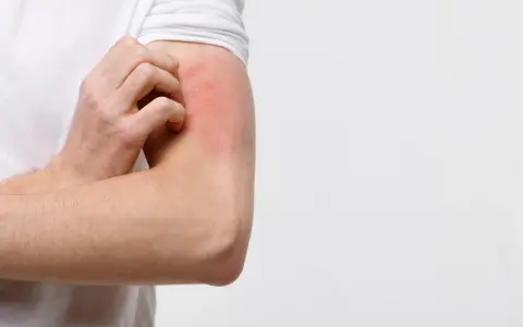 Braccio con arrossamento e prurito, possibile eczema diabetico.