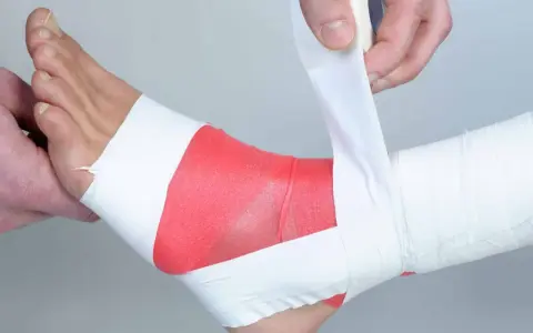 Applicazione di bendaggio ossido di zinco sulla caviglia per supporto e protezione.
