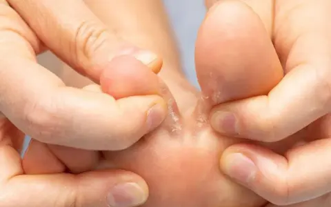 Dita dei piedi con pelle secca e screpolata tra le dita. Un podologo cosa fa? Aiuta a trattare queste condizioni.