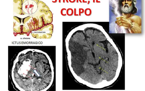 Immagini mediche mostrano ictus cerebrali, emorragici e ischemici. La vasculopatia cerebrale cronica può influenzare l'aspettativa di vita.